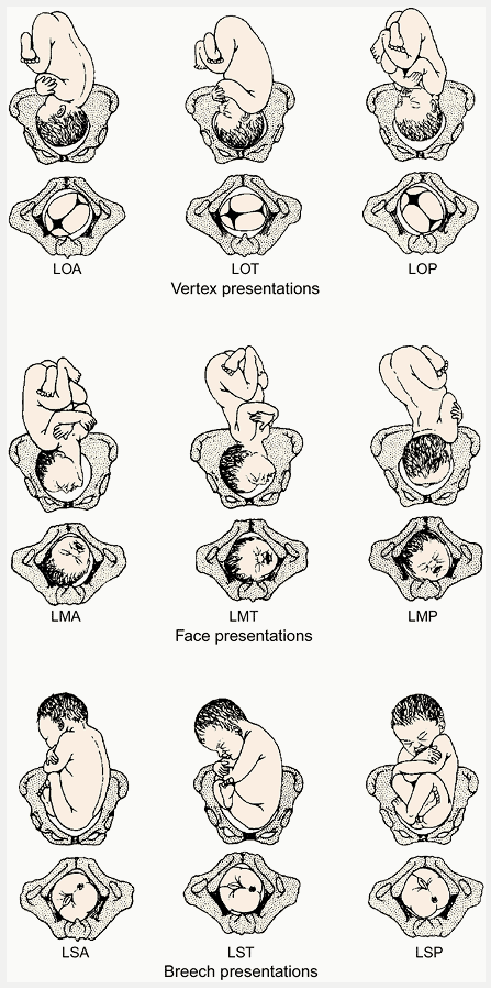 Diagram of fetal positions, my son was LMT